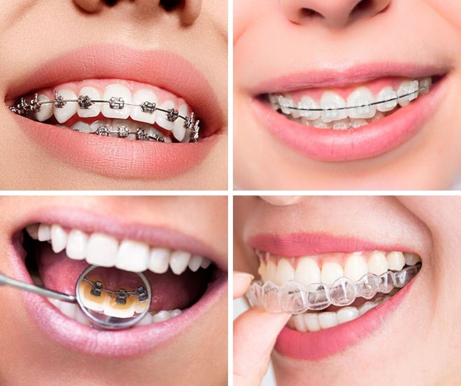 Tipos de Ortodoncia - Alcantarilla, Murcia | Clínica Dental Dra. Ana Belén Martínez
