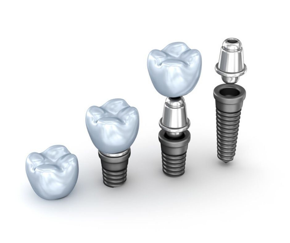 Tipos de Implantes Dentales - Alcantarilla | Clínica Dental Dra. Ana Belén Martínez