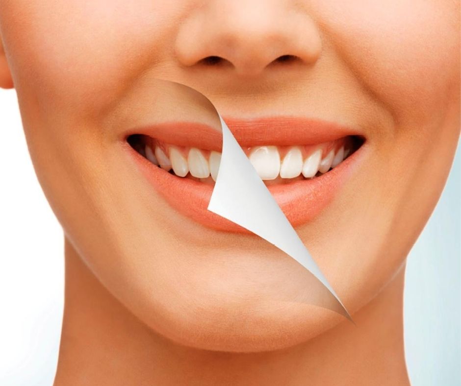 Tipos de Blanqueamiento Dental - Alcantarilla - Clínica Dental Dra. Ana Belén Martínez