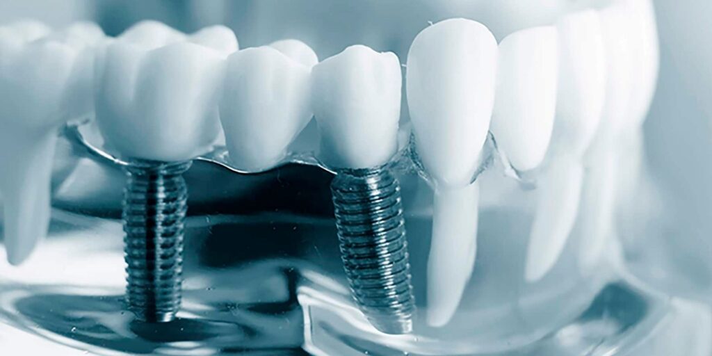 Implantes Dentales en Alcantarilla, Murcia | Clínica Dental Dra. Ana Belén Martínez