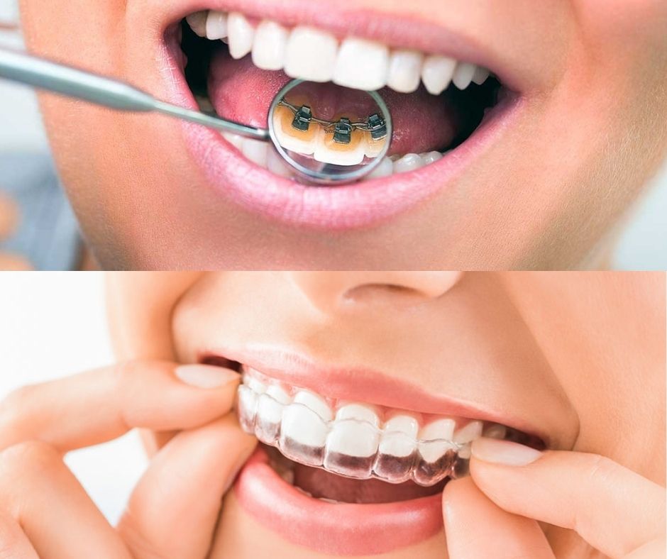 Tipos de Ortodoncia Invisible - Alcantarilla - Murcia | Clínica Dental Dra. Ana Belén Martínez