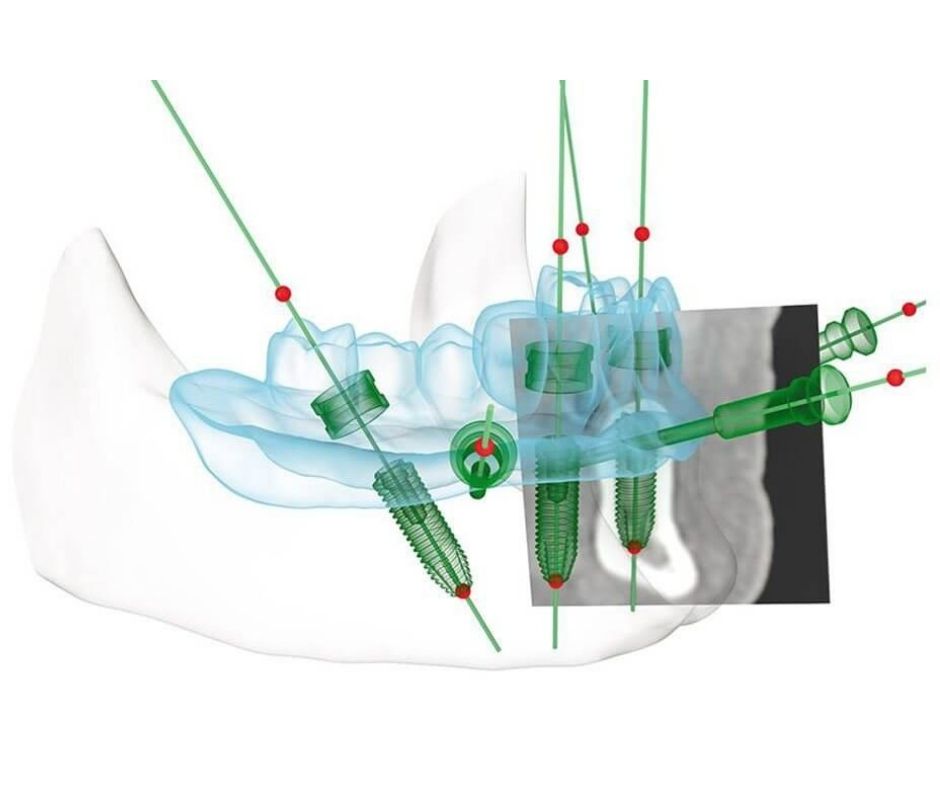 Cirugía Guiada por Ordenador Implantes Dentales - Alcantarilla | Clínica Dental Dra. Ana Belén Martínez