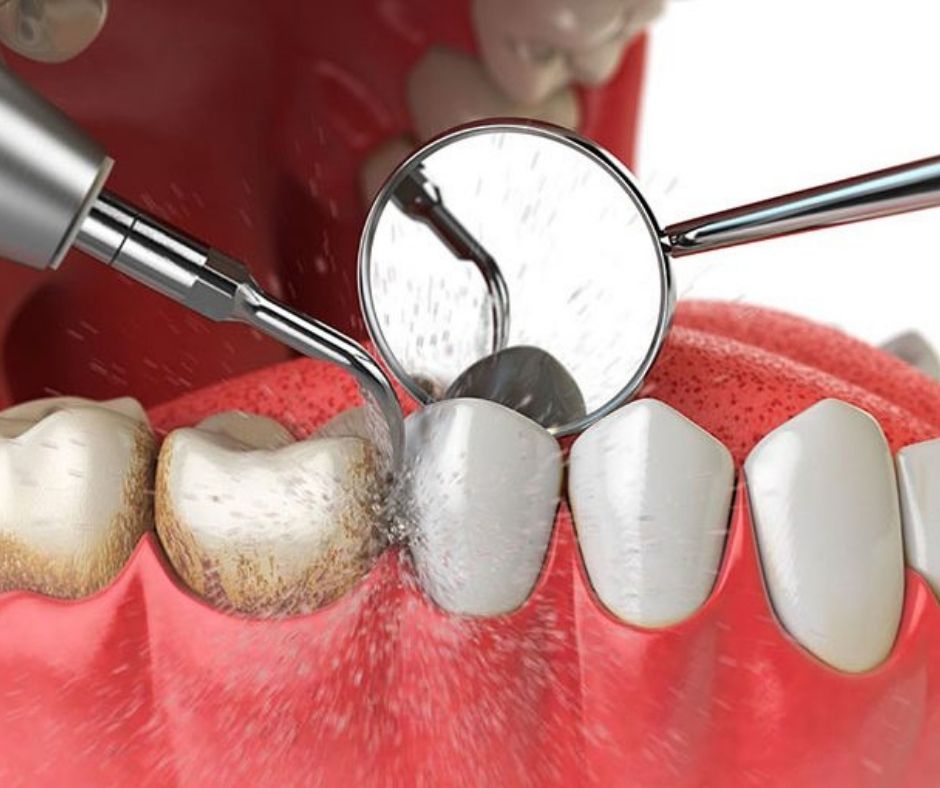 Curetaje Dental - Alcantarilla | Clínica Dental Dra. Ana Belén Martínez