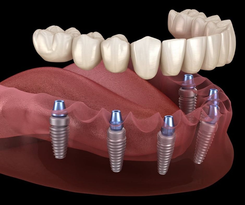 Implantes con Carga Inmediata - Alcantarilla | Clínica Dental Dra. Ana Belén Martínez