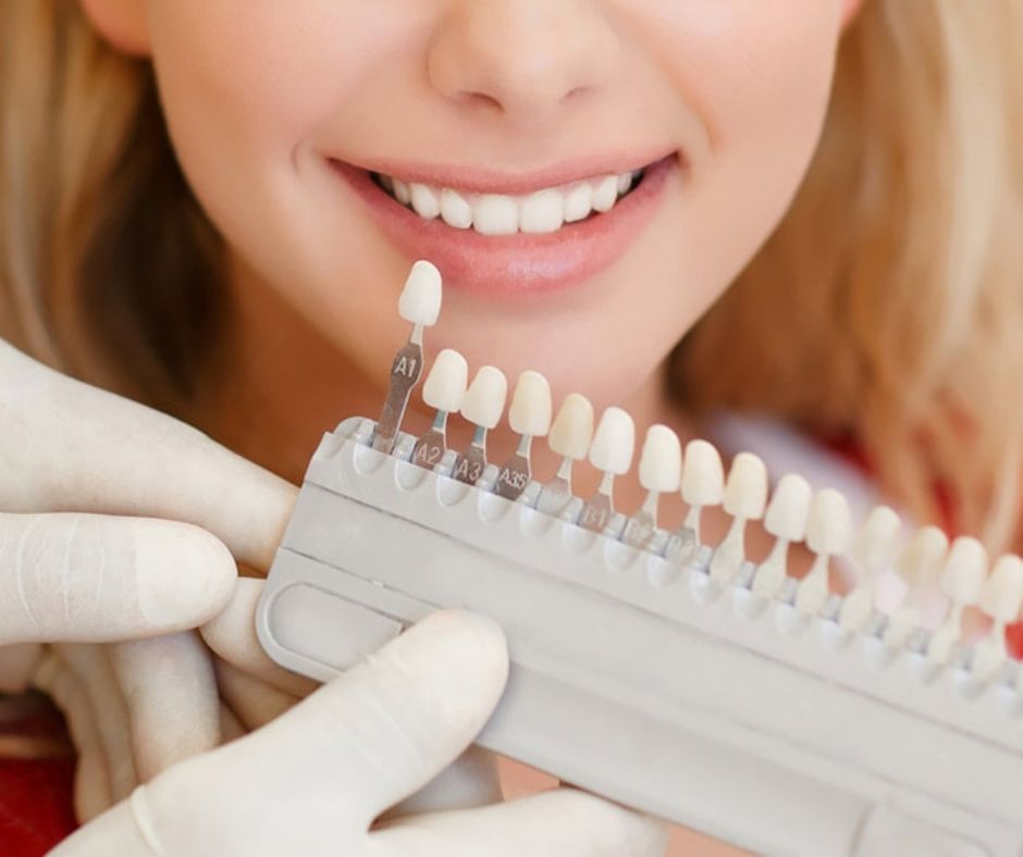 ¿Cuánto dura el blanqueamiento dental? - Dentista en Alcantarilla | Dra. Ana Belén Martínez